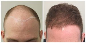 hair restoration fue transplant hair loss manchester before after photos the private clinic 300x150 1