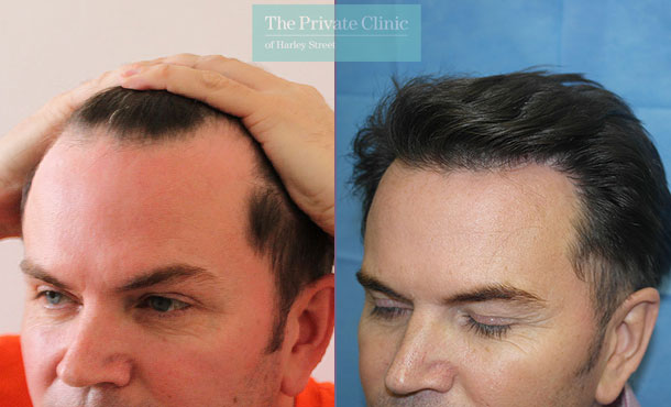 FUE Hair Transplant - 072RR-Side