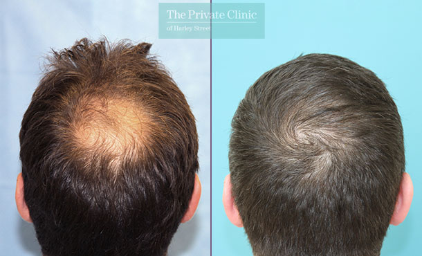 FUE Hair Transplant -129RR-Crown