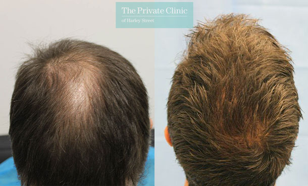 FUE Hair Transplant - 045RR