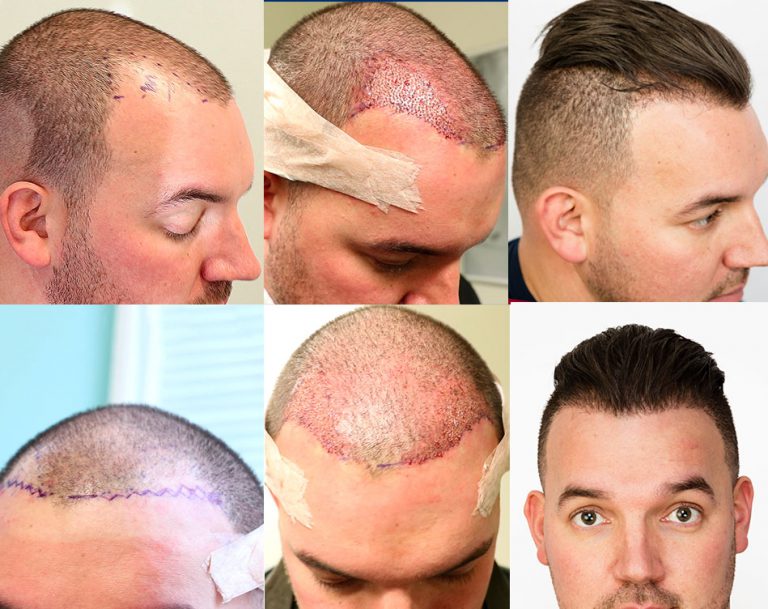 Receding Hairline Transplantation Surgery Fue Hair Transplant Before And After 