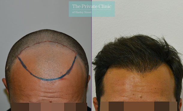 FUE Hair Transplant - 001LDF