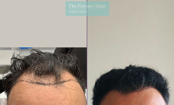 FUE Hair Transplant - 002FR