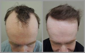 hair transplant before after photos fue mark tam bristol web 300x185 1