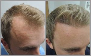 hair transplant before after photos fue mark tam leeds web 300x185 1