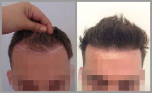 hair transplant before after photos fue michail mouzakis birmingham web 300x185 1