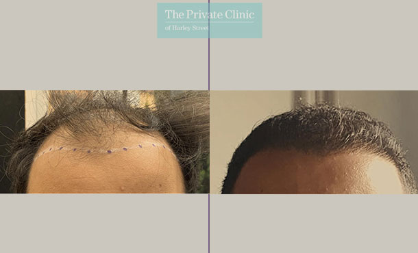 FUE Hair Transplant - 001FR