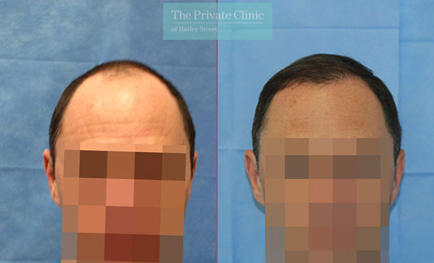 FUE Hair Transplant -100RR-Front