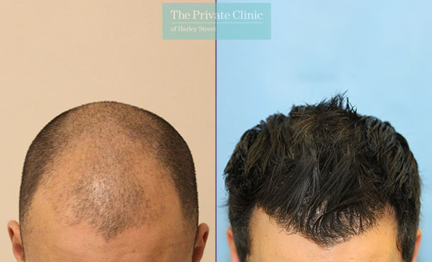 FUE Hair Transplant - 021RR