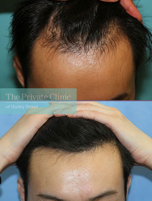 hair transplant before after results dr raghu reddy 114RR hair transplant before after results dr raghu reddy 114RR