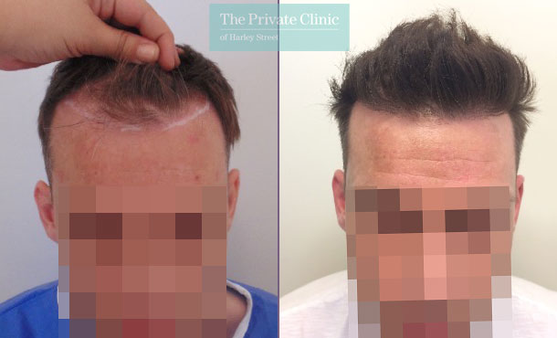 hair transplant bristol before after photo results mr michael mouzakis front 001MM