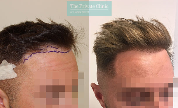 FUE Hair Transplant - 010MM-Side