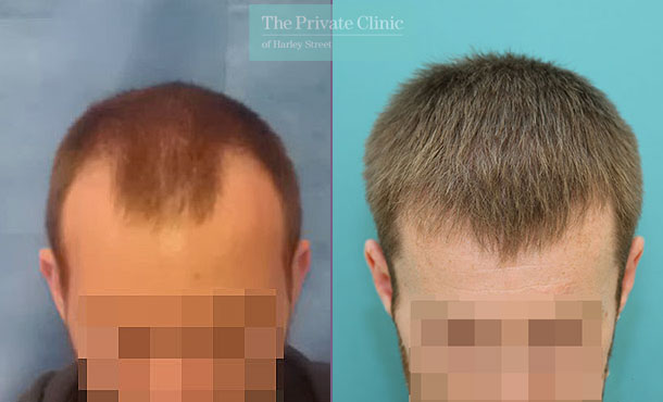 FUE Hair Transplant - 108RR