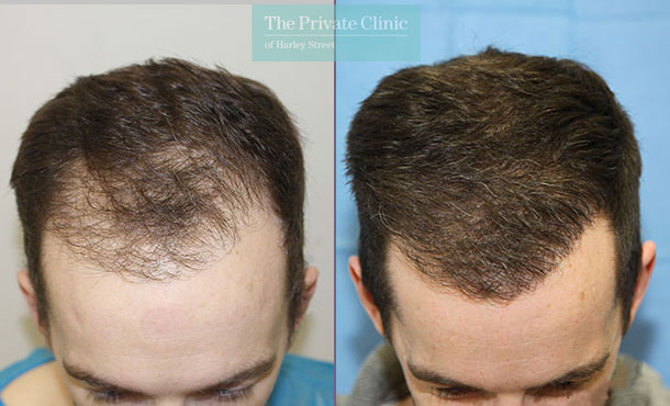 FUE Hair Transplant - 065RR