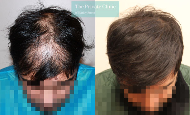 FUE Hair Transplant - 001RR