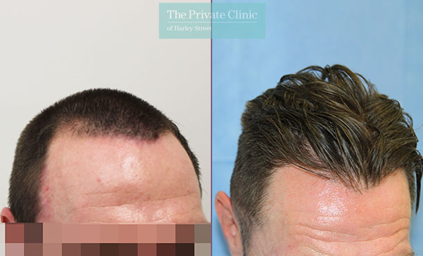 FUE Hair Transplant - 015RR