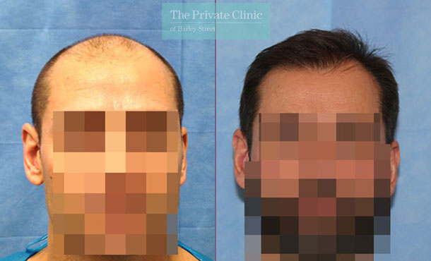 FUE Hair Transplant - 019RR-Front