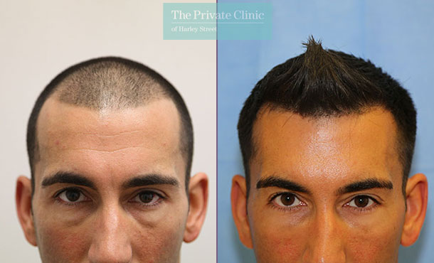 FUE Hair Transplant - 066RR