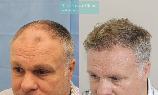 FUE Hair Transplant - 088RR-Side