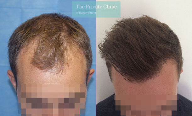 FUE Hair Transplant - 098RR