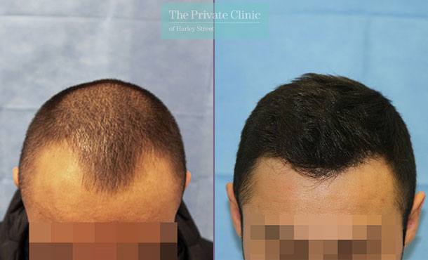 FUE Hair Transplant - 103RR