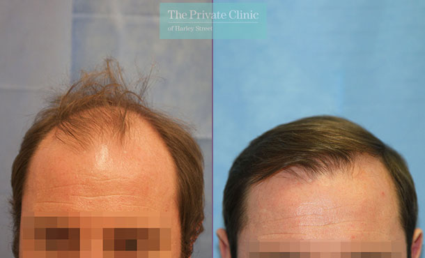 FUE Hair Transplant - 093RR-Front