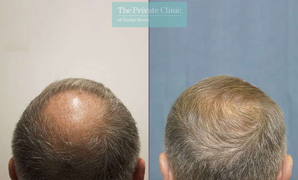 FUE Hair Transplant - 085RR-Crown