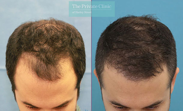 FUE Hair Transplant - 012RR-Front