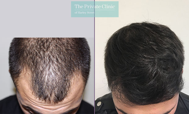 FUE Hair Transplant - 006MM