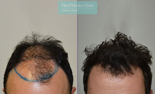 hair transplant procedure before after photos results dr luca de fazio 002LDF