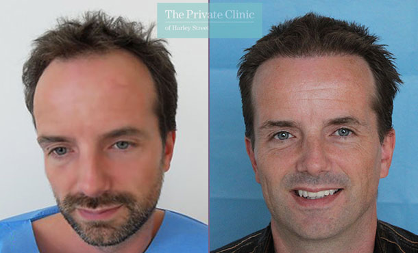 FUE Hair Transplant - 022RR-Front