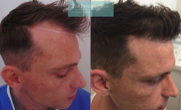 hair transplant procedure before after photos results mr michael mouzakis side