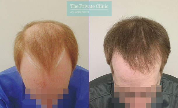 hair transplant procedure fue before after results mr michael mouzakis front 002MM