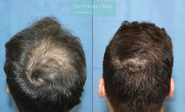 FUE Hair Transplant - 102RR-Crown