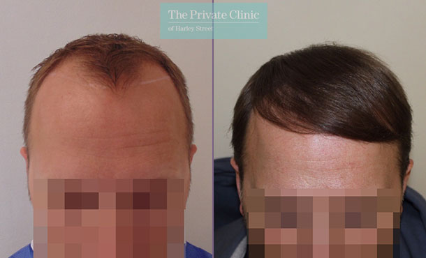 FUE Hair Transplant - 003MM