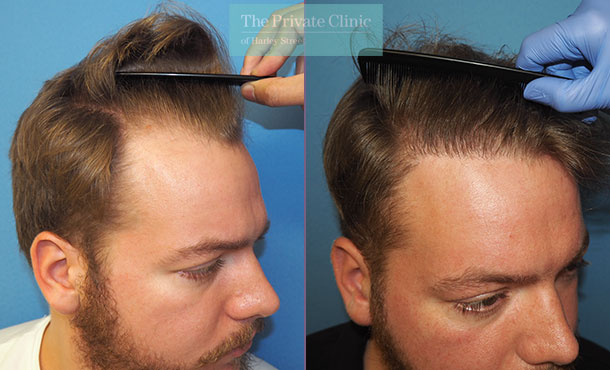 hair transplant recovery before after photo results mr michael mouzakis side 015MM
