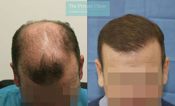 FUE Hair Transplant - 089RR