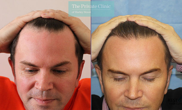 FUE Hair Transplant - 072RR-Front