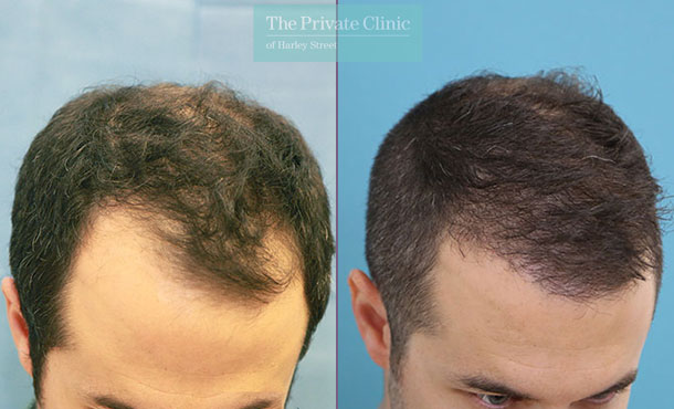 FUE Hair Transplant - 012RR-Side