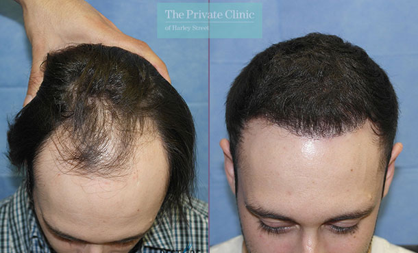 FUE Hair Transplant - 086RR-Front