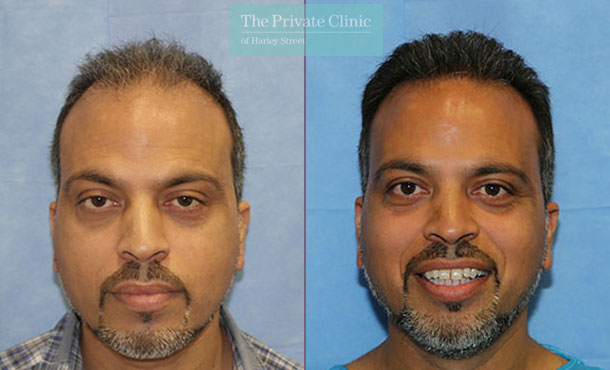 FUE Hair Transplant - 110RR