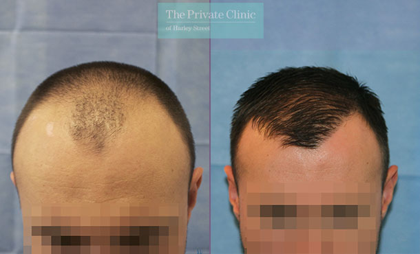 FUE Hair Transplant - 078RR-Front