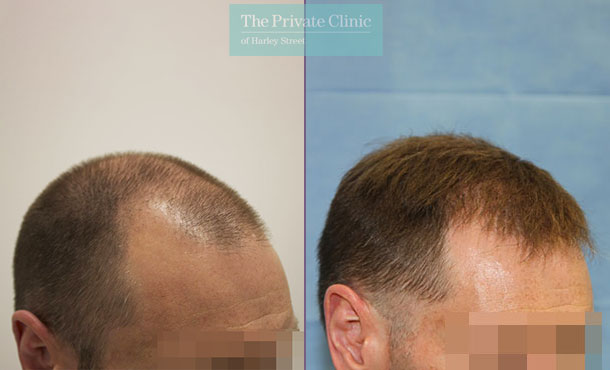 FUE Hair Transplant - 106RR-Side