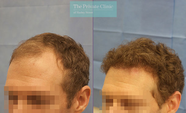 FUE Hair Transplant - 080RR-Side