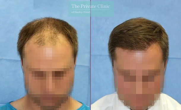 FUE Hair Transplant - 113RR