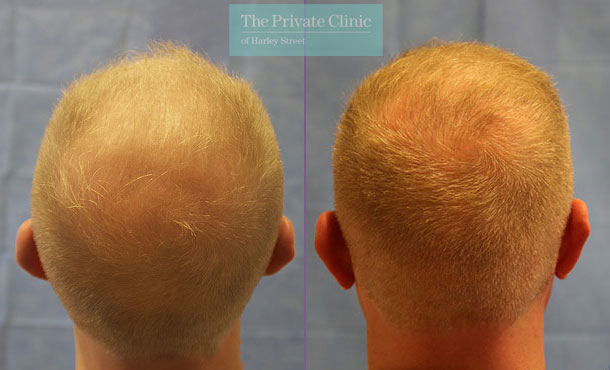 FUE Hair Transplant - 109RR-Crown