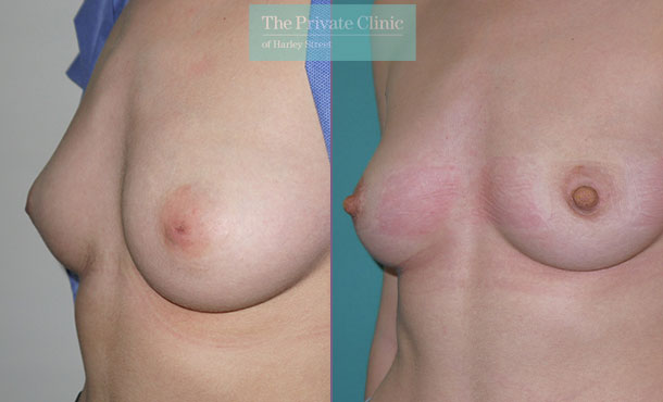 inverted nipple before after photo results uk side Miles Berry 008MB