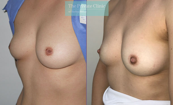 Inverted Nipple Correction - 009MB