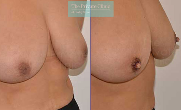 inverted nipple surgery before after photo uk results adrian richards 034AR