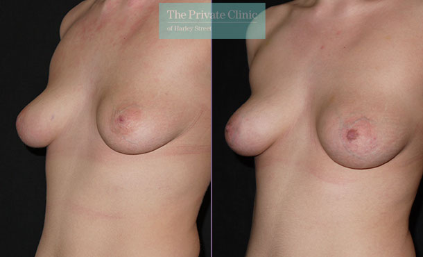 inverted nipple surgery before after photos london results Miles Berry 006MB